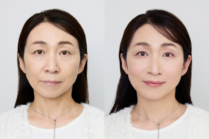 顔の影&たるみを払拭