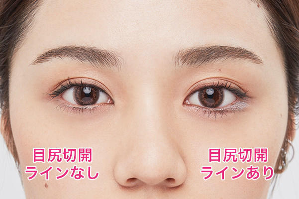 目尻切開ラインだけでこんなに変わる!
